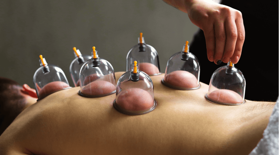 Myofascial Cupping Therapy